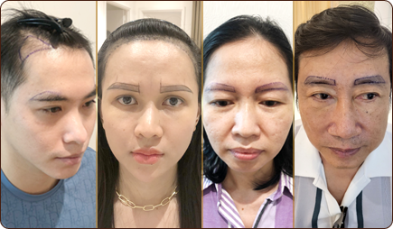 cấy ghép tóc y học