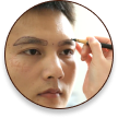 cấy ghép tóc y học
