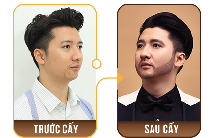 cấy ghép tóc y học
