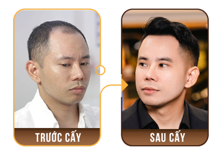 cấy ghép tóc y học