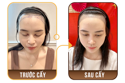 cấy ghép tóc y học