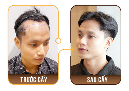 cấy ghép tóc y học