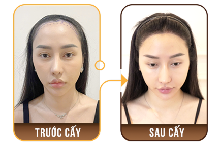 cấy ghép tóc y học