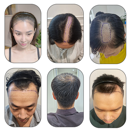 cấy ghép tóc y học