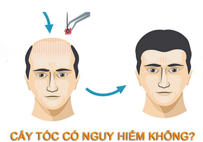 Cấy tóc có nguy hiểm không? Địa chỉ cấy tóc an toàn và uy tín hiện nay