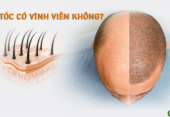 Cấy tóc có vĩnh viễn không? Mách bạn địa chỉ cấy tóc uy tín