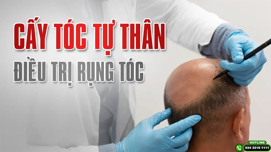 cấy tóc có vĩnh viễn không