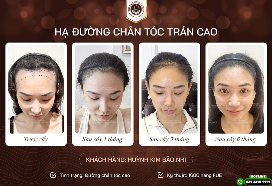 cấy tóc có vĩnh viễn không