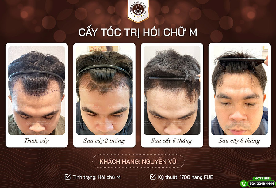 cấy tóc có vĩnh viễn không