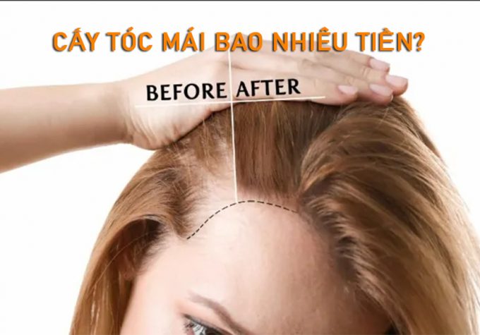 Cấy tóc mái bao nhiêu tiền? Cập nhật bảng giá mới nhất