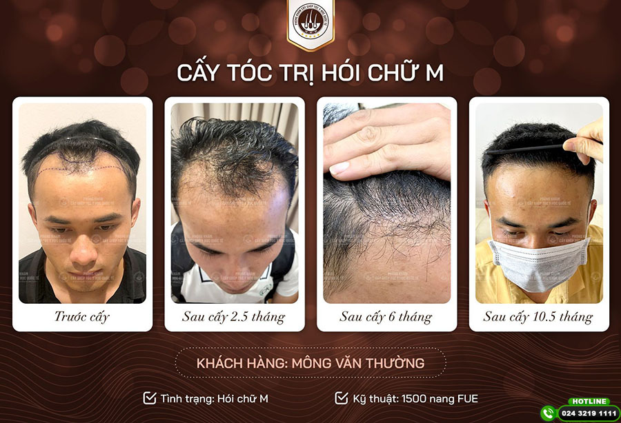 cấy tóc mái bao nhiêu tiền