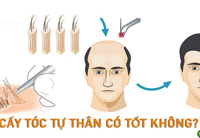 Cấy tóc tự thân có tốt không? Cần lưu ý gì trước khi cấy tóc?