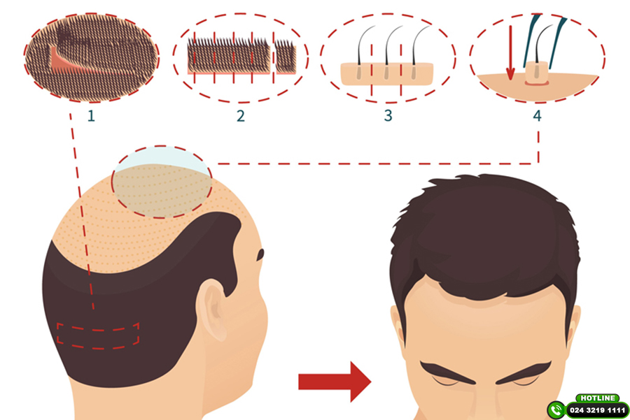 cấy tóc tự thân có tốt không