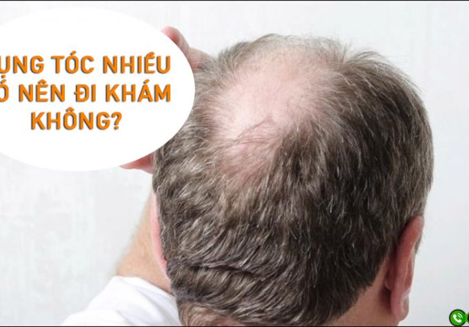 Rụng tóc nhiều có nên đi khám không? Mách bạn địa chỉ khám rụng tóc chất lượng