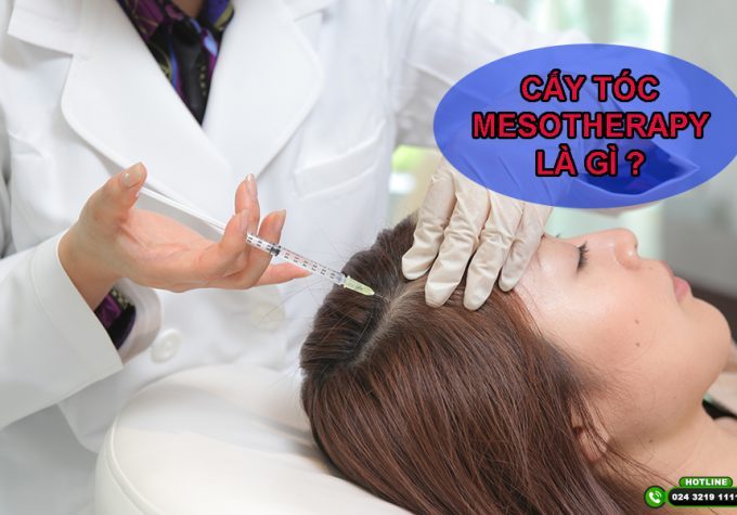 Cấy tóc Mesotherapy là gì? Có nên thực hiện không?