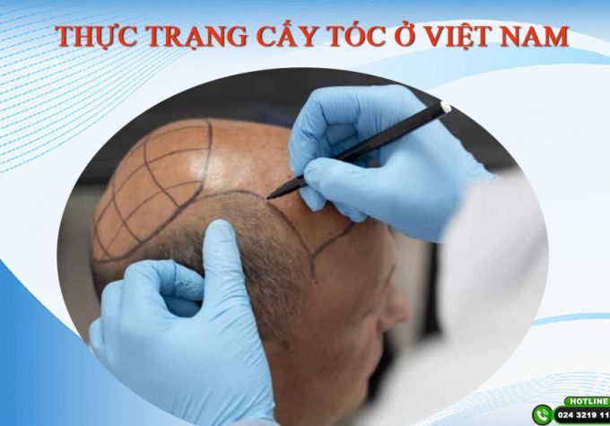 Thực trạng cấy tóc ở Việt Nam bạn nhất định phải biết để tránh tiền mất tật mang