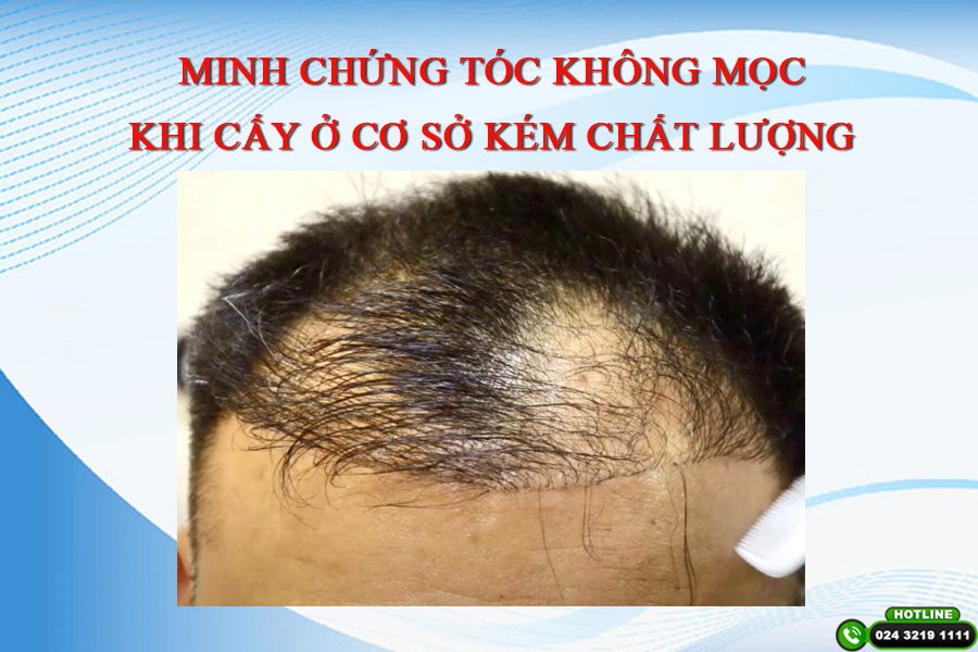 cấy tóc ở việt nam