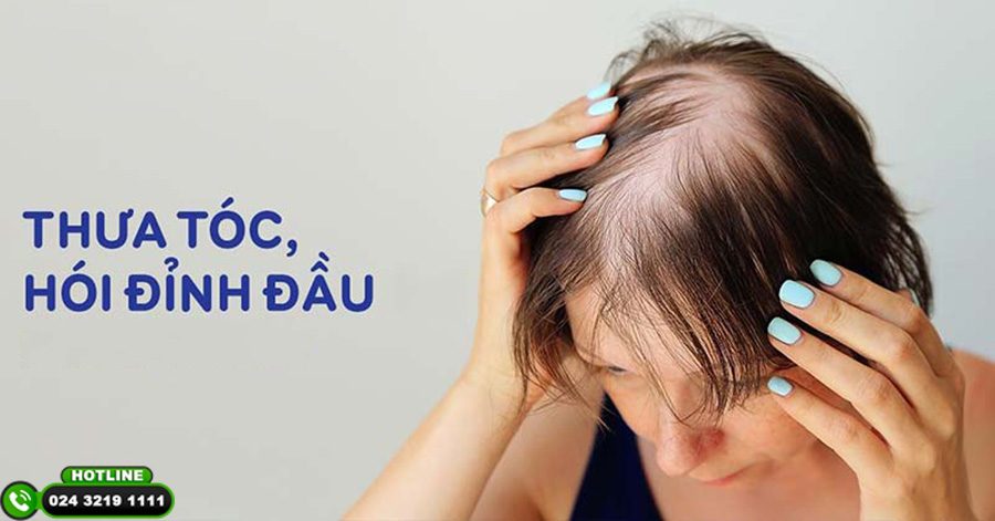 cấy tóc ở việt nam