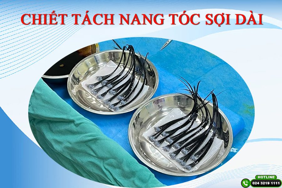 cấy tóc PNS