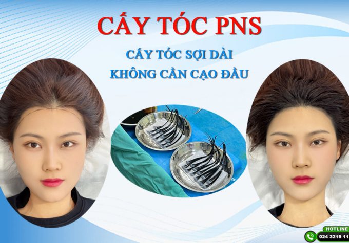 Cấy tóc PNS – Cấy tóc sợi dài không cạo đầu mở ra cuộc cách mạng mới trong điều trị hói đầu