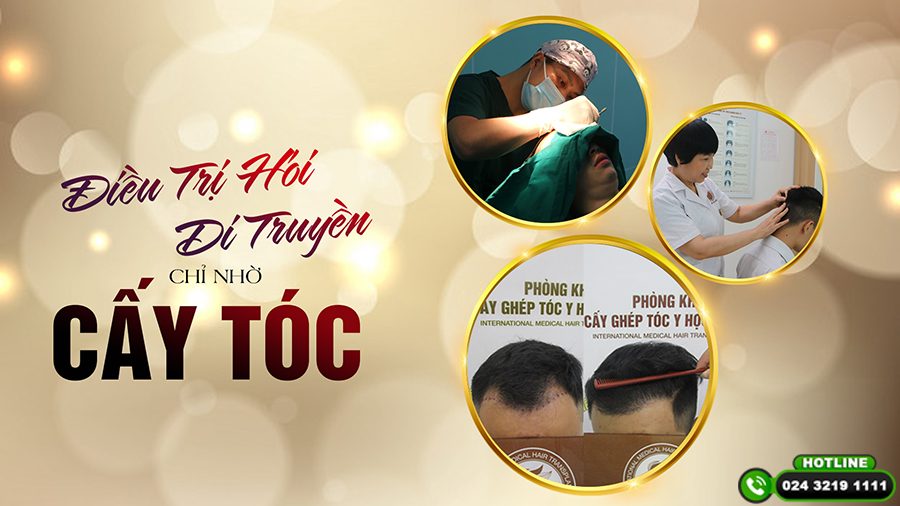 cấy tóc review