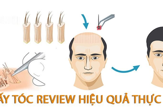 Cấy tóc review có hiệu quả không? Địa chỉ cấy tóc uy tín tại Hà Nội và Sài Gòn