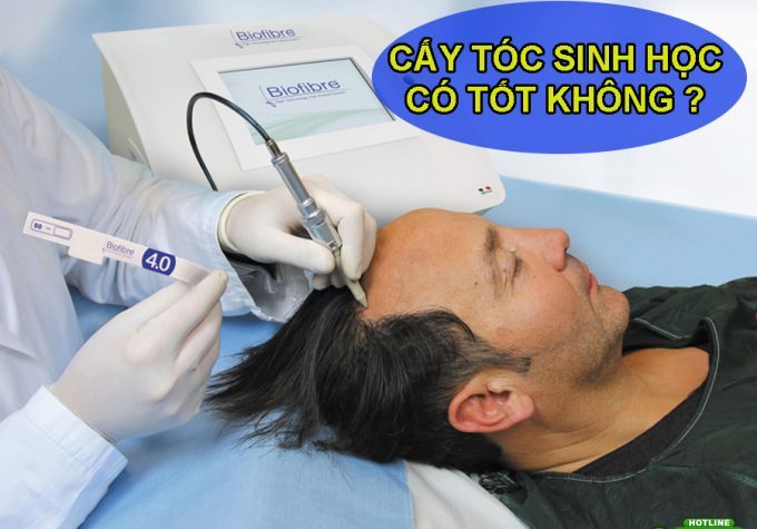 Cấy tóc sinh học có tốt không? Có nên tiến hành cấy tóc nhân tạo?