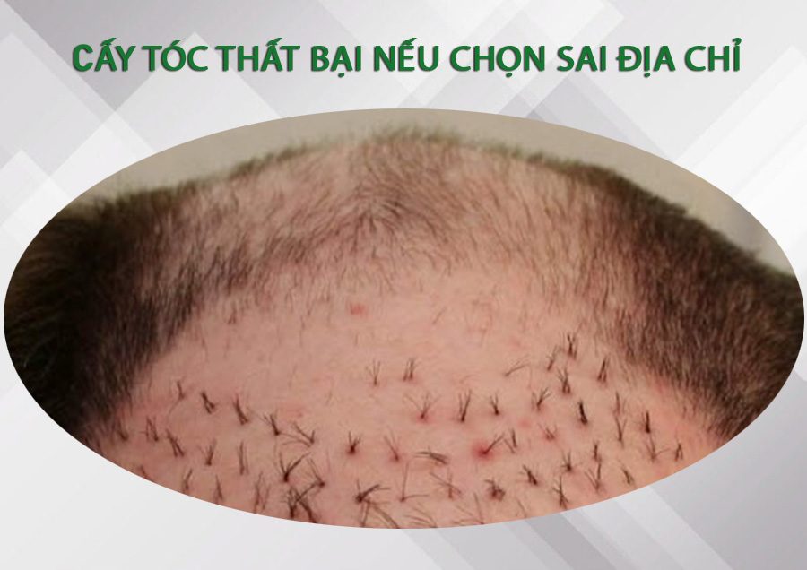 chi phí cấy tóc bệnh viện da liễu