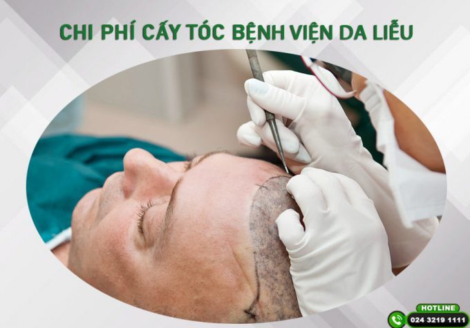 [Bật mí] Chi phí cấy tóc Bệnh viện Da liễu bao nhiêu tiền? Có nên cấy tóc ở bệnh viện da liễu không?