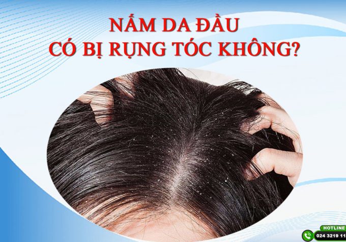 [Giải đáp] Nấm da đầu có bị rụng tóc không? Vì sao sau điều trị tóc vẫn rụng, không mọc lại?