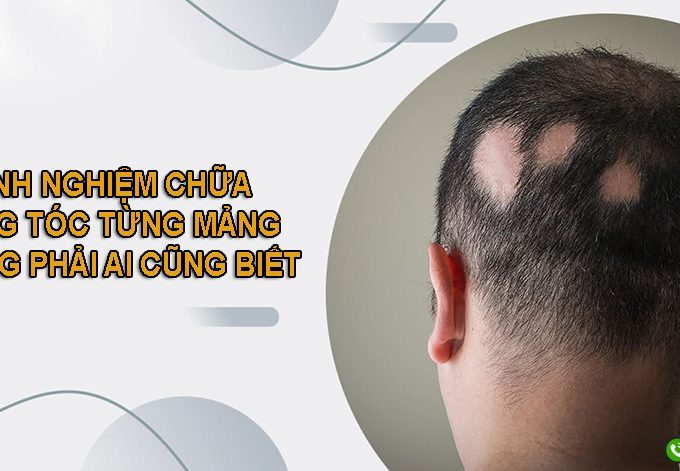 Kinh nghiệm chữa rụng tóc từng mảng không phải ai cũng biết