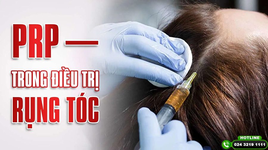 tiêm cấy tóc prp