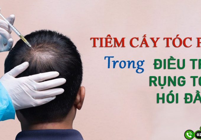 Phương pháp tiêm cấy tóc PRP là gì? Tiêm PRP có giúp mọc tóc thật không?