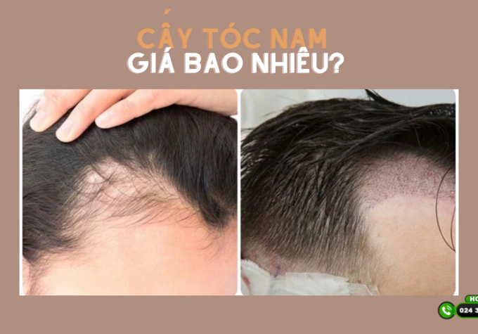 Giá cấy tóc nam hết bao nhiêu? Bảng giá cấy tóc nam tại Viện Cấy tóc Quốc tế