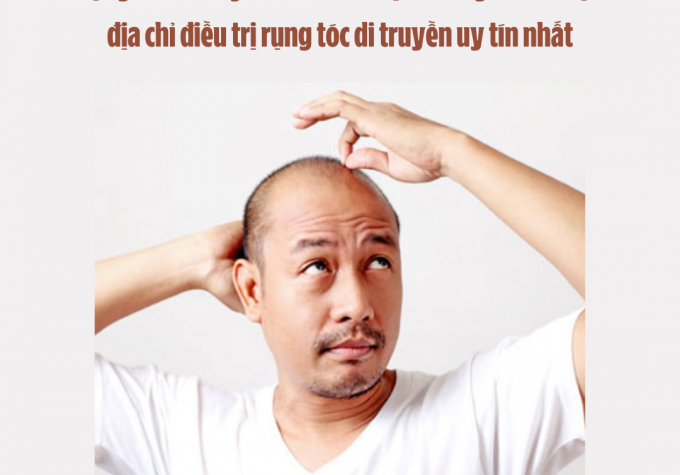 Rụng tóc di truyền có chữa được không? Mách bạn địa chỉ điều trị rụng tóc di truyền uy tín nhất