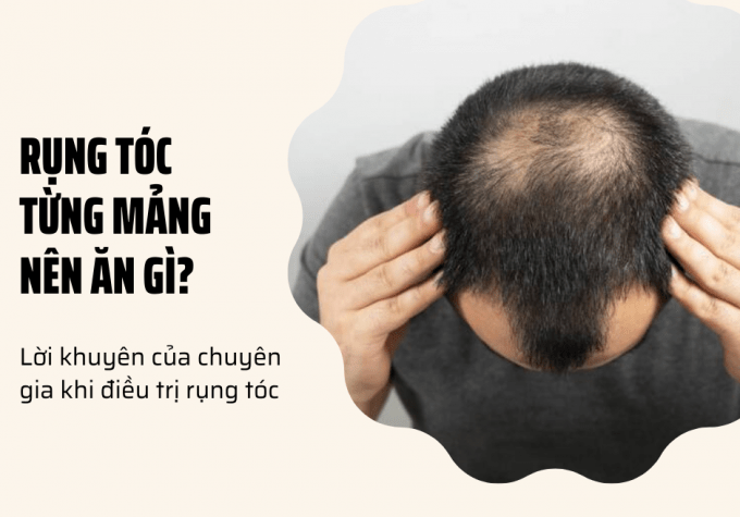 Rụng tóc từng mảng nên ăn gì? Lời khuyên của chuyên gia khi điều trị rụng tóc 