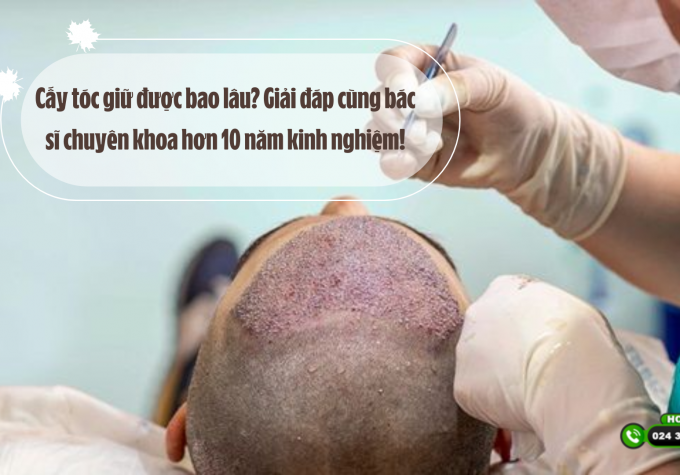 Cấy tóc giữ được bao lâu? Giải đáp cùng bác sĩ chuyên khoa hơn 10 năm kinh nghiệm!