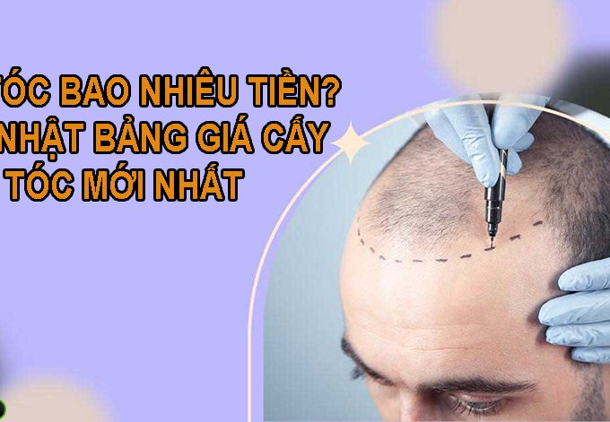 Cấy tóc bao nhiêu tiền? Cập nhật bảng giá cấy tóc mới nhất