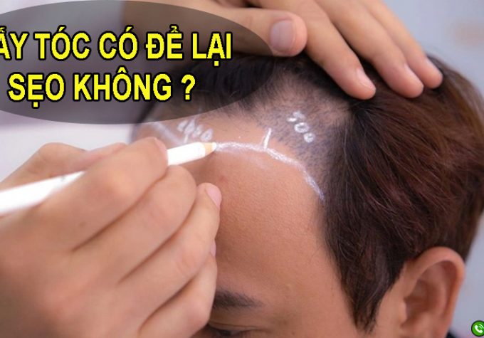 [GIẢI ĐÁP VẤN ĐỀ] : CẤY TÓC CÓ ĐỂ LẠI SẸO KHÔNG?