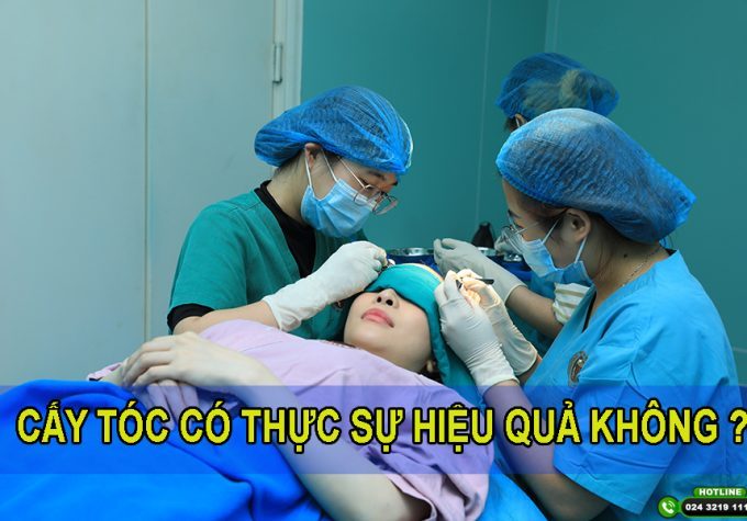 Cấy tóc có thực sự hiệu quả không? Thời gian duy trì của tóc sau cấy là bao lâu?