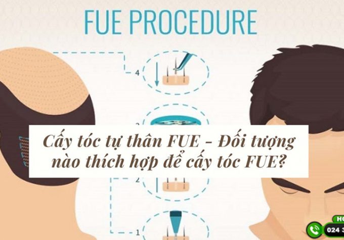 Cấy tóc FUE – Giải pháp xóa sổ rụng tóc, hói đầu chỉ sau 1 lần thực hiện