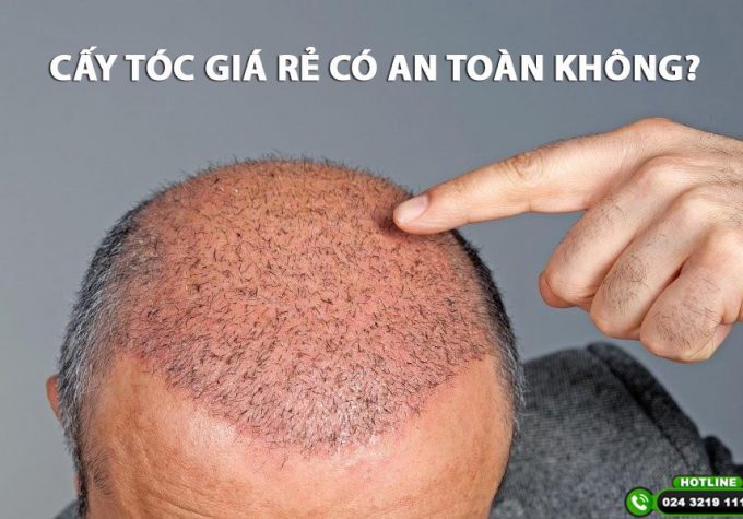 Cấy tóc giá rẻ có an toàn không? Địa chỉ cấy tóc uy tín