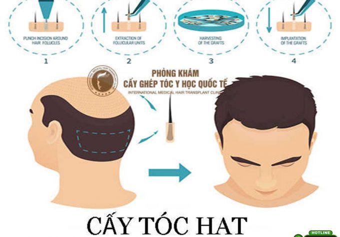 Cấy tóc HAT là gì? Kỹ thuật này khác biệt gì so với cấy tóc FUE?