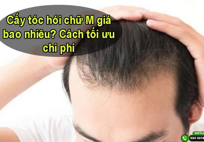 Cấy tóc hói chữ M giá bao nhiêu? Cách tối ưu chi phí mà vẫn đảm bảo hiệu quả