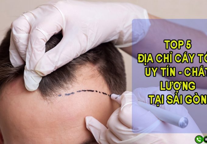 Mách bạn 5 địa chỉ cấy tóc Sài Gòn uy tín và tốt nhất