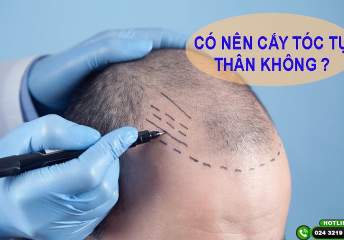 [GIẢI ĐÁP] : CÓ NÊN CẤY TÓC TỰ THÂN KHÔNG?