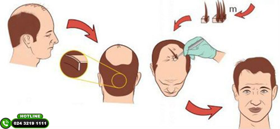 giá cấy tóc nam