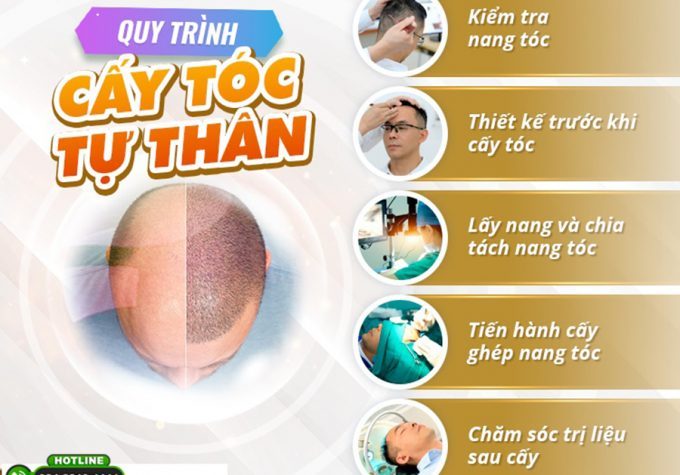 Liệu trình cấy tóc diễn ra như thế nào? Những điều cần lưu ý sau khi cấy tóc