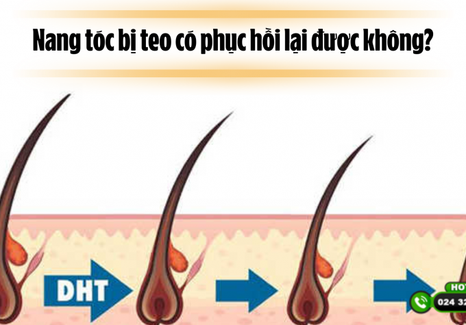 Nang tóc bị teo có phục hồi lại được không? Chuyên gia giải đáp và cho lời khuyên