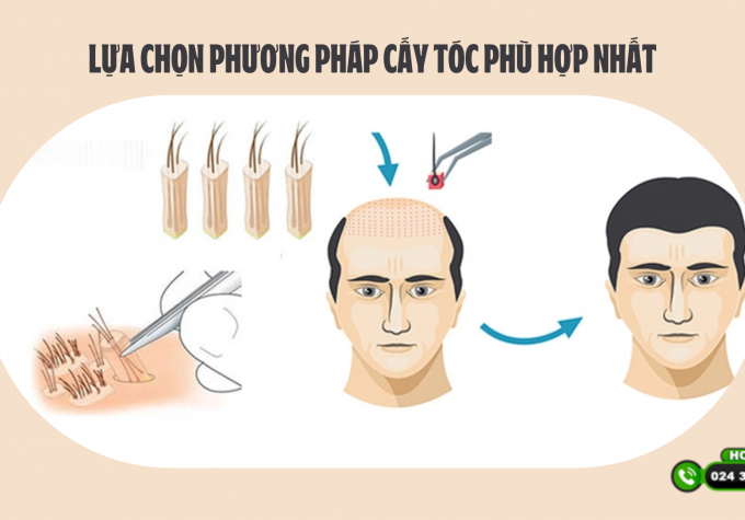 Lựa chọn phương pháp cấy tóc phù hợp nhất